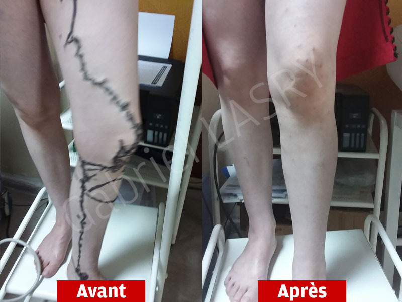 resultats-operation-varices-avant-apres3 Avant/Après